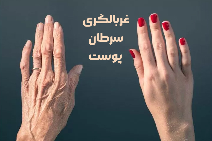 غربالگری سرطان‌ پوست