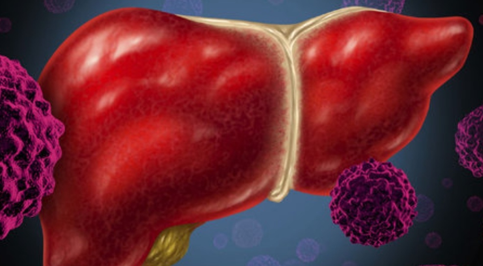 هپاتیت C در ایران قابل ریشه‌کنی است