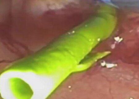 پیوند شگفت‌انگیز آهن و انسولین؛ روزنه‌ای تازه برای محافظت از لوزالمعده