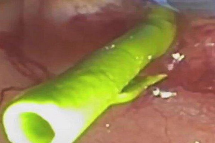 پیوند شگفتانگیز آهن و انسولین؛ روزنهای تازه برای محافظت از لوزالمعده