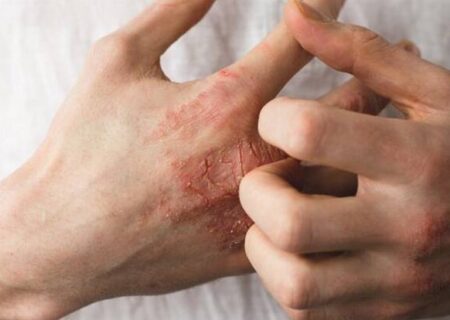 توصیه‌هایی درباره یک عارضه پوستیِ شایع
