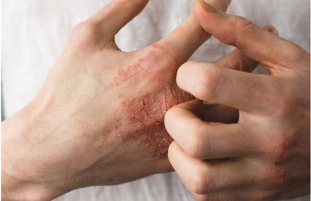 توصیه‌هایی درباره یک عارضه پوستیِ شایع