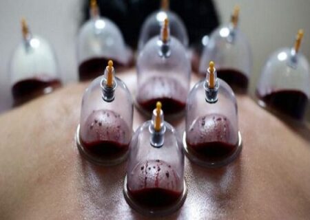 حجامت توسط افراد غیر متخصص خطرناک است
