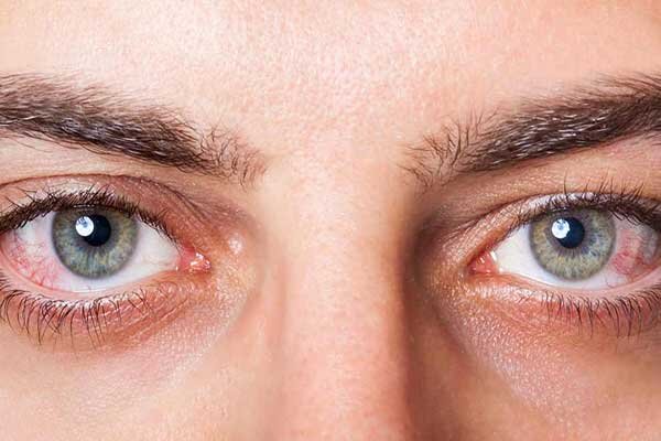 دیابت، شایعترین علت قابل پیشگیری کوری